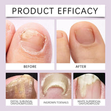Load image into Gallery viewer, Fungi Free Bee Venom Nail Treatment Solution Serum (15ml)
